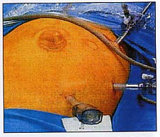 View of exposed abdominal wall in operating room during herniorrhaphy