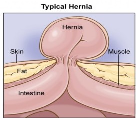 typical hernia